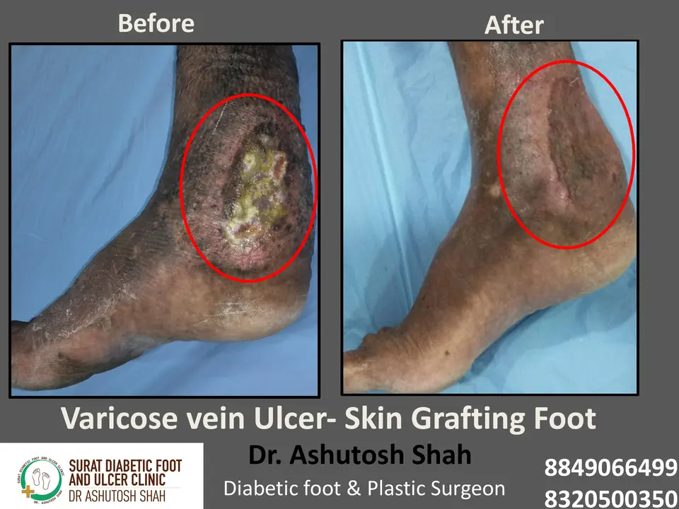 Diabetic Foot  PPT 3 checked by sir.pptx-23.webp